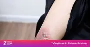 Chi hơn 85 triệu đồng xóa xăm, người phụ nữ TP.HCM đau đớn nhập viện
