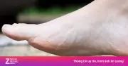 Cần làm gì ngay khi giẫm phải vật nhọn để tránh uốn ván?