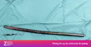 Công nhân 37 tuổi nhập viện vì thanh xà beng 1,5 m đâm xuyên đùi