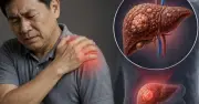 Cảnh báo đau vai kéo dài có thể là dấu hiệu ung thư gan