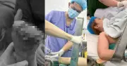 Cảnh báo tai nạn máy xay thịt: Ngón tay dập nát, mất bàn tay