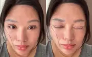 Cắt mí hỏng vì phòng khám 'chui': Người phụ nữ sống 6 năm không thể nhắm mắt