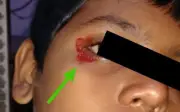 Cậu bé 11 tuổi chảy máu mắt, tai vì áp lực học tập