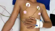 Cứu sống bé trai bị ong vò vẽ đốt nguy kịch ở Cà Mau