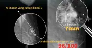 Dự báo nguy cơ tim mạch 10 năm nhờ AI và chỉ số mỡ thượng tâm mạc