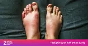 Dấu hiệu cảnh báo thận yếu: Phù nề, tiểu đêm, nước tiểu bất thường
