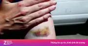 Dấu hiệu xơ gan giai đoạn đầu dễ bỏ qua: Mệt mỏi, sụt cân, ngứa da