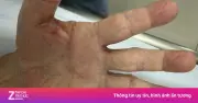 Hai mẹ con ở Tây Ninh cùng mắc bệnh ghẻ do ký sinh trùng tưởng đã biến mất