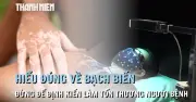 Hiểu đúng về bạch biến: Đừng để định kiến làm tổn thương người bệnh