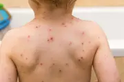 Khỏi thủy đậu chưa hết nguy cơ: Virus 'ngủ đông' gây bệnh zona