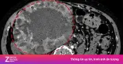 Khối u gan tăng gấp 10 lần vì tự ý uống thuốc nam