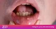 Không chỉ cơn đau: Ho kéo dài, mệt mỏi, loét miệng có thể là dấu hiệu ung thư