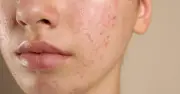 Kháng kháng sinh trong điều trị mụn và giải pháp từ Cold Plasma