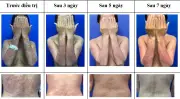 Liệu pháp sinh học mới điều trị vảy nến thể mủ toàn thân hiệu quả
