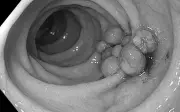Nữ sinh 17 tuổi bị đa polyp đại tràng nguy kịch, bác sĩ cảnh báo