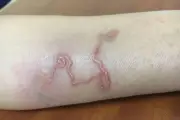 Nghệ sĩ Chí Trung mất ngủ vì ngứa do nhiễm ấu trùng giun đũa chó mèo