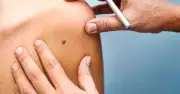 Nghiên cứu mới phát hiện hàng trăm gen liên quan nốt ruồi và ung thư da