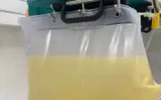 Người đàn ông 29 tuổi bị viêm tụy cấp, tiểu đường vì nghiện trà sữa và nước ngọt