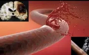 Người đàn ông 43 tuổi xuất huyết não thừa nhận 1 sai lầm nhiều người Việt mắc phải
