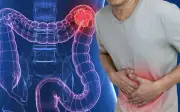 Người đàn ông 45 tuổi phát hiện ung thư đại tràng di căn từ dấu hiệu nhiều người Việt mắc phải