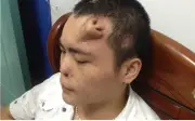 Người đàn ông có mũi mọc trên trán: Sự thật kỳ lạ từ ca phẫu thuật tái tạo