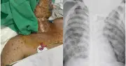 Người đàn ông nguy kịch vì thủy đậu biến chứng nặng, mụn nước khắp người