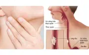 Người đàn ông phát hiện ung thư thực quản thừa nhận 2 sai lầm nhiều người Việt mắc