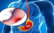 Người phụ nữ 39 tuổi không đau bụng vẫn phát hiện ung thư dạ dày: Bác sĩ chỉ ra dấu hiệu ít ai ngờ tới