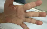 Người phụ nữ 71 tuổi nhập viện vì ngứa toàn thân do ghẻ lây từ con gái