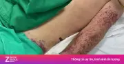 Nguy kịch sau ăn lòng lợn, người đàn ông suýt mất mạng vì liên cầu lợn