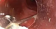 Nội soi gắp ghim nhọn 3 cm trong dạ dày bé 10 tuổi tại Lâm Đồng