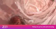 Phụ nữ 52 tuổi ung thư đại trực tràng di căn vì thói quen tiết kiệm