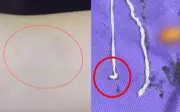 Phụ nữ Trung Quốc phát hiện giun dài 10 cm trong khối u ở cánh tay