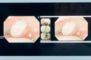 Phát hiện sớm ung thư đại trực tràng: Cơ hội sống cao nhờ công nghệ nội soi 520x