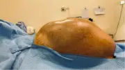 Phẫu thuật khối u buồng trứng gần 15kg cho nữ sinh 16 tuổi
