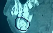 Phẫu thuật lấy gần 50 chiếc răng nhỏ trong khối u hiếm gặp ở hàm bé trai 13 tuổi