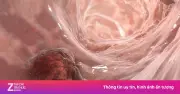 Sụt cân, tiêu chảy kéo dài, người đàn ông phát hiện mắc 5 loại ung thư