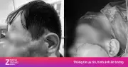 Từ nốt nhỏ vùng má, người đàn ông phát hiện ung thư da gây biến dạng khuôn mặt