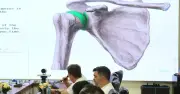 Thay khớp vai toàn phần giải phẫu cho nam bệnh nhân 32 tuổi bị tiêu chỏm xương