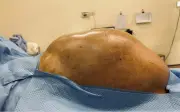 Thiếu nữ 16 tuổi mang khối u buồng trứng gần 15kg, bác sĩ khuyến cáo không chủ quan với dấu hiệu bất thường