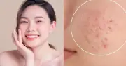 Trioderma Gentle Matte Soothing Lotion: Giải pháp phục hồi da dầu mụn mùa hè gây sốt TikTok