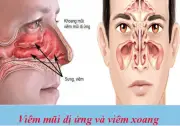 Vì sao mùa hè dễ bị hắt hơi, sổ mũi? Bác sĩ chỉ cách phân biệt viêm mũi dị ứng và viêm xoang