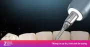 Vì sao nên lấy vôi răng thường xuyên? Lợi ích sức khỏe răng miệng bất ngờ