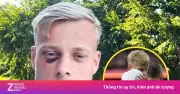 Vết bầm tím quanh mắt của Van Hecke gây sốc khi ra mắt Tottenham