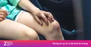 Xơ gan giai đoạn đầu: 7 dấu hiệu cảnh báo thường bị bỏ qua