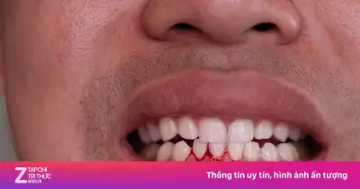 4 dấu hiệu cảnh báo gan tổn thương qua khuôn mặt