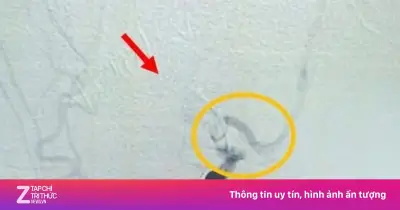 Bé gái 15 tuổi bị đột quỵ nhồi máu não, liệt nửa người sau can thiệp