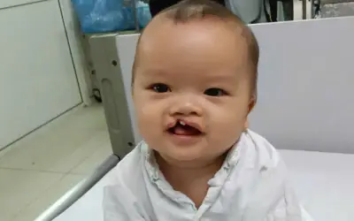 Bé trai 8 tháng tuổi bị bỏ rơi trước cổng chùa cần phẫu thuật dị tật môi hàm ếch