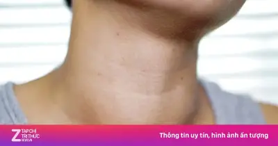 Bác sĩ cảnh báo 5 nhóm người dễ mắc ung thư tuyến giáp