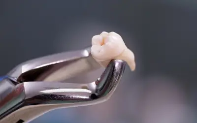 Bệnh nhân 83 tuổi sốc nhiễm khuẩn sau nhổ răng khôn